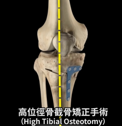高位脛骨截骨矯正手術固定板示意圖