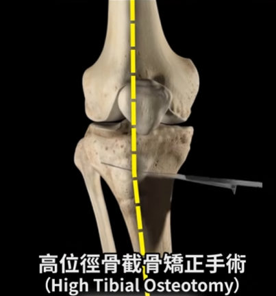 高位脛骨截骨矯正手術示意圖