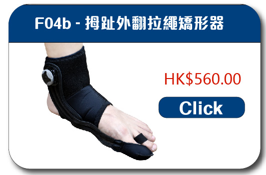 拇趾外翻