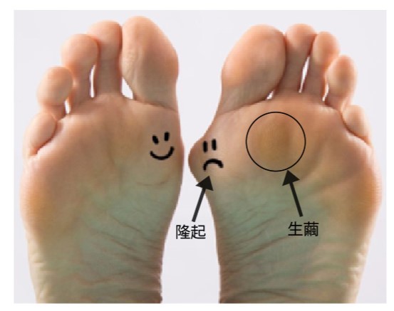 拇趾外翻