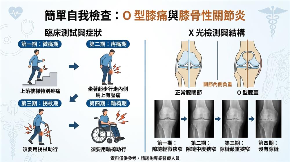 O型膝痛與膝骨性關節炎簡單自我檢查