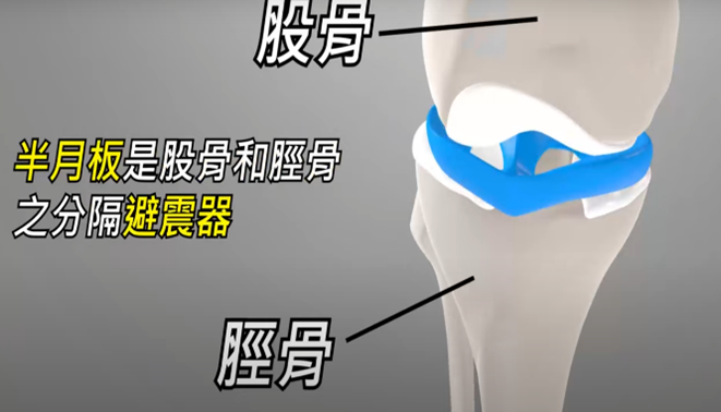 半月板撕裂