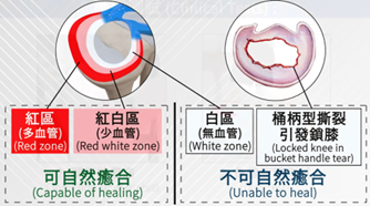 半月板撕裂
