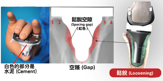 人工膝關節骨水泥與鬆脫空隙示意圖