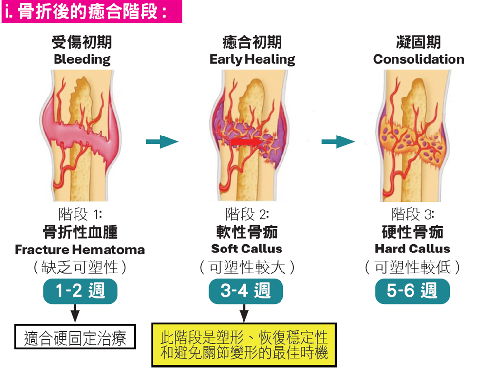 足踝骨折三個癒合階段示意圖
