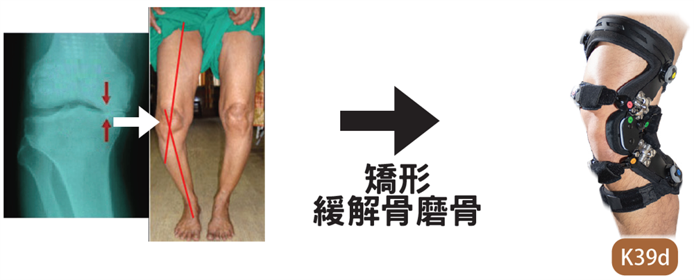 膝骨性關節炎