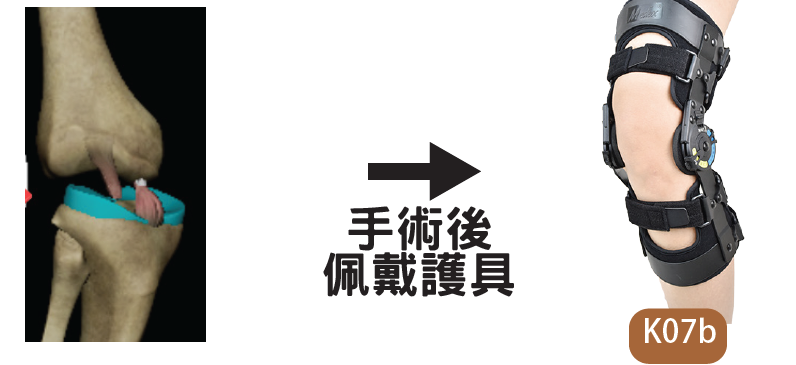 十字韌帶完全撕裂