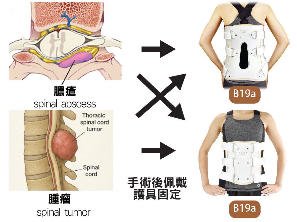 嚴重脊髓受壓
