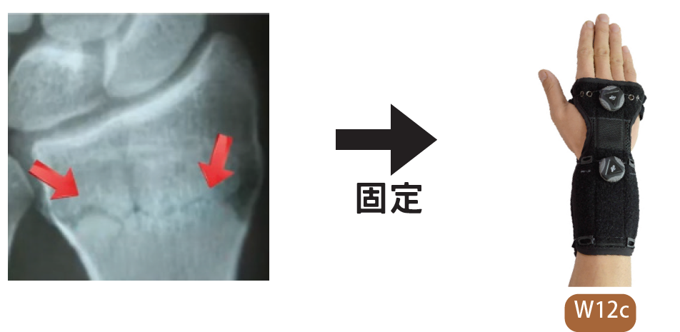 無移位穩定性橈骨骨折