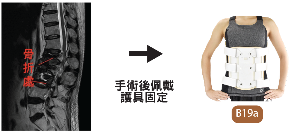 腰椎嚴重骨折