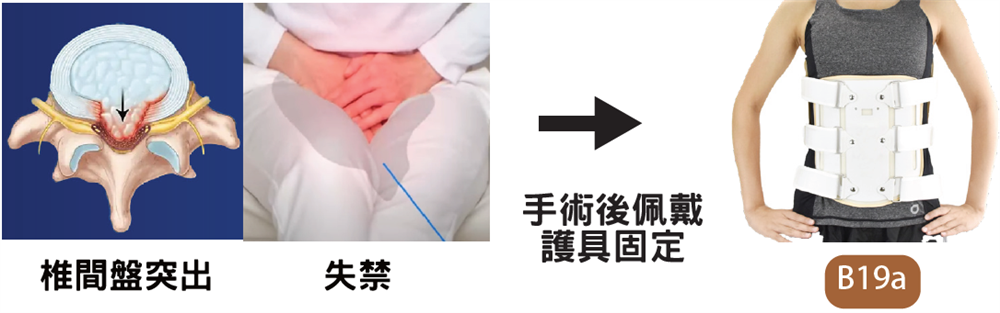 馬尾神經嚴重受壓